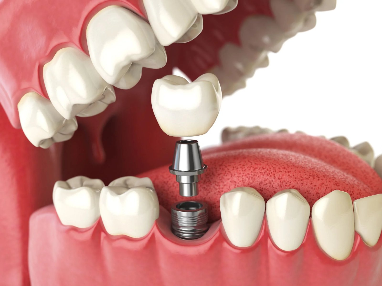 Tooth Replacement